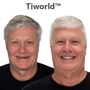 Tiworld™ Custom-Fit Full Functional Dentures