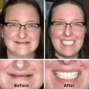 SmileFitPro™–Advanced Custom-Fit Functional Dentures