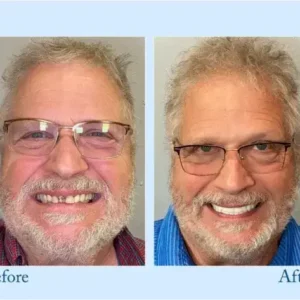 Smileasego™ – Premium-Zahnprothese