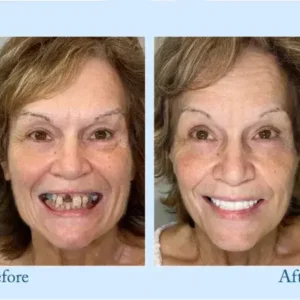 Smileasego™ – Premium-Zahnprothese