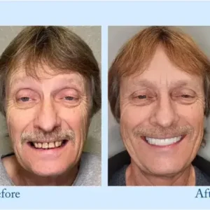 Smileasego™ – Premium-Zahnprothese