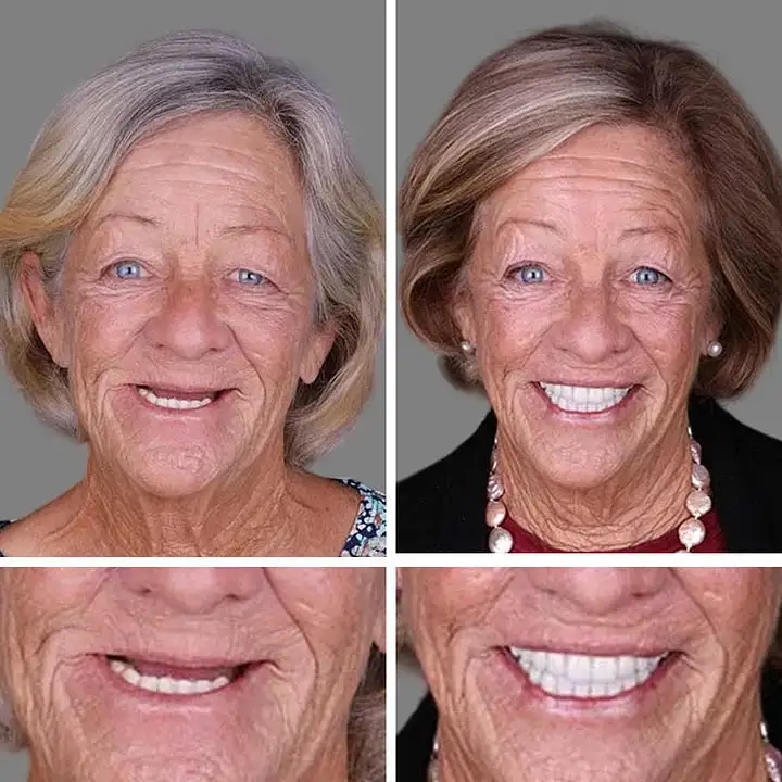 2026 NEW Upgraded 2.0🏆🌎Ends Today: 70% OFF! ⏰Fantasfeelets™ Medical Full Denture with Strong Suctiond🦷Obtain American Dental Association (ADA) Certification