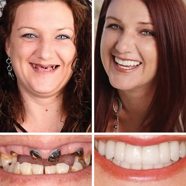 2026 NEW Upgraded 2.0🏆🌎Ends Today: 70% OFF! ⏰Fantasfeelets™ Medical Full Denture with Strong Suctiond🦷Obtain American Dental Association (ADA) Certification
