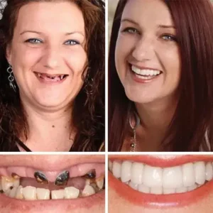 HazyGalaxy™ Soft Silicone Carbon Ceramic Teeth, Strong and White – Natural Look, Comfortable Fit
