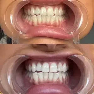Skavix® Whitening Mouthwash | Fresh Breath