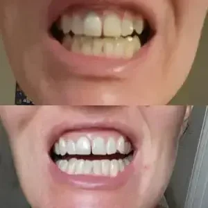 Skavix® Whitening Mouthwash | Fresh Breath
