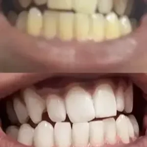 Skavix® Whitening Mouthwash | Fresh Breath