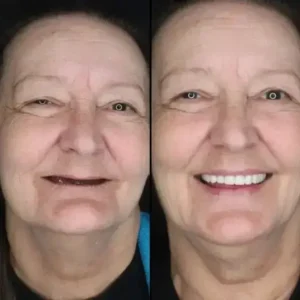 BQYOOM™-Custom-Fit Functional Dentures