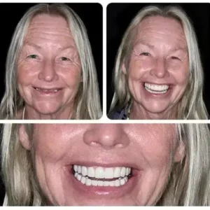 BQYOOM™-Custom-Fit Functional Dentures