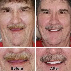BQYOOM™-Custom-Fit Functional Dentures