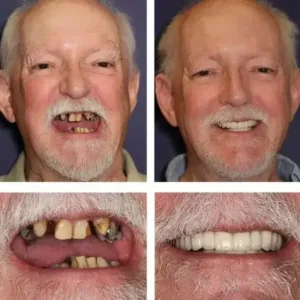 BQYOOM™-Custom-Fit Functional Dentures