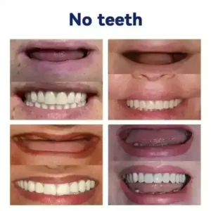 HEATWOLF Full Denture Set | Custom Fit Upper & Lower Dentures
