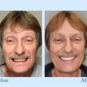 TrueEase™ Dentures